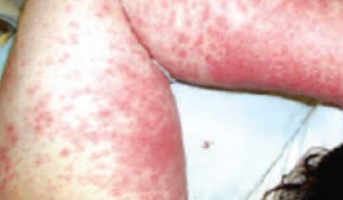 Skin Allergy
